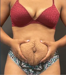 Real patient results in New York, NY Craig Baldenhofer MD