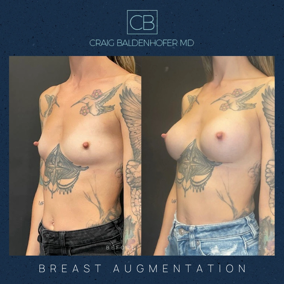 Real patient results in New York, NY Done by Craig Baldenhofer, MD