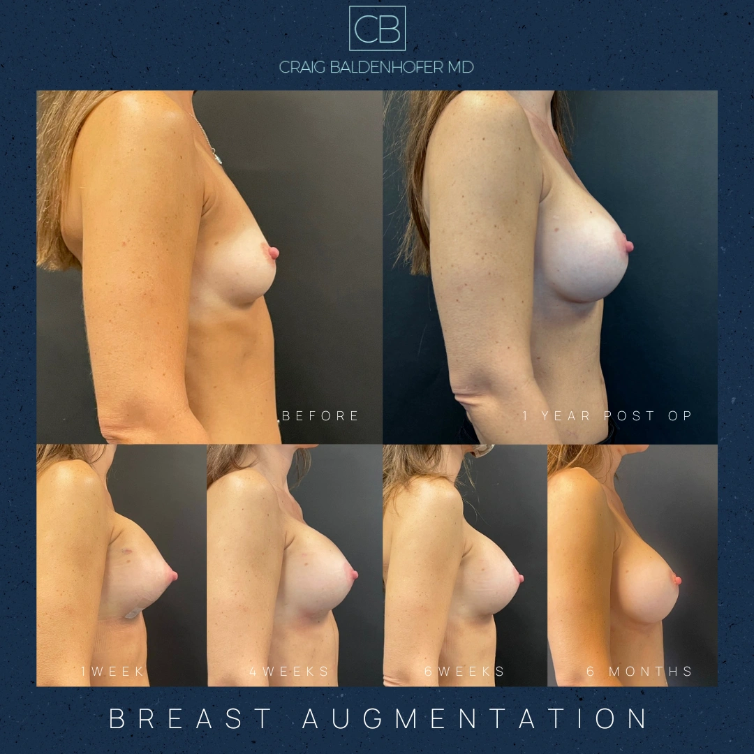 Real patient results in New York, NY Done by Craig Baldenhofer, MD