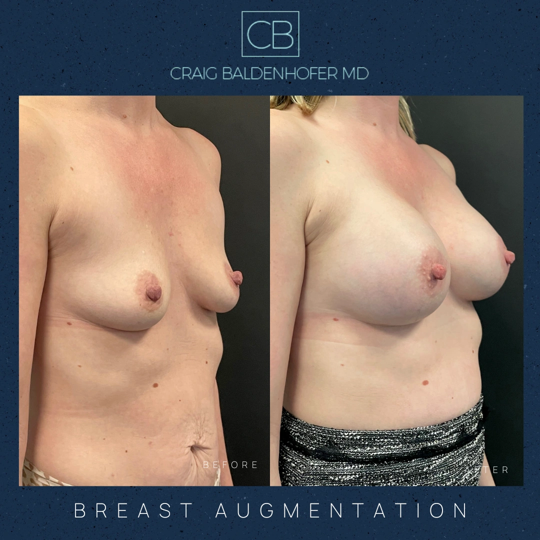 Real patient results in New York, NY Done by Craig Baldenhofer, MD