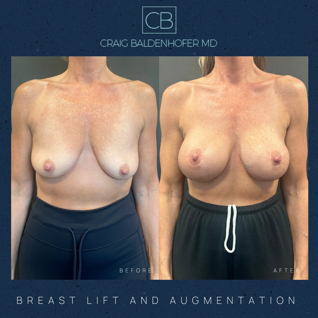 Real patient results in New York, NY Done by Craig Baldenhofer, MD