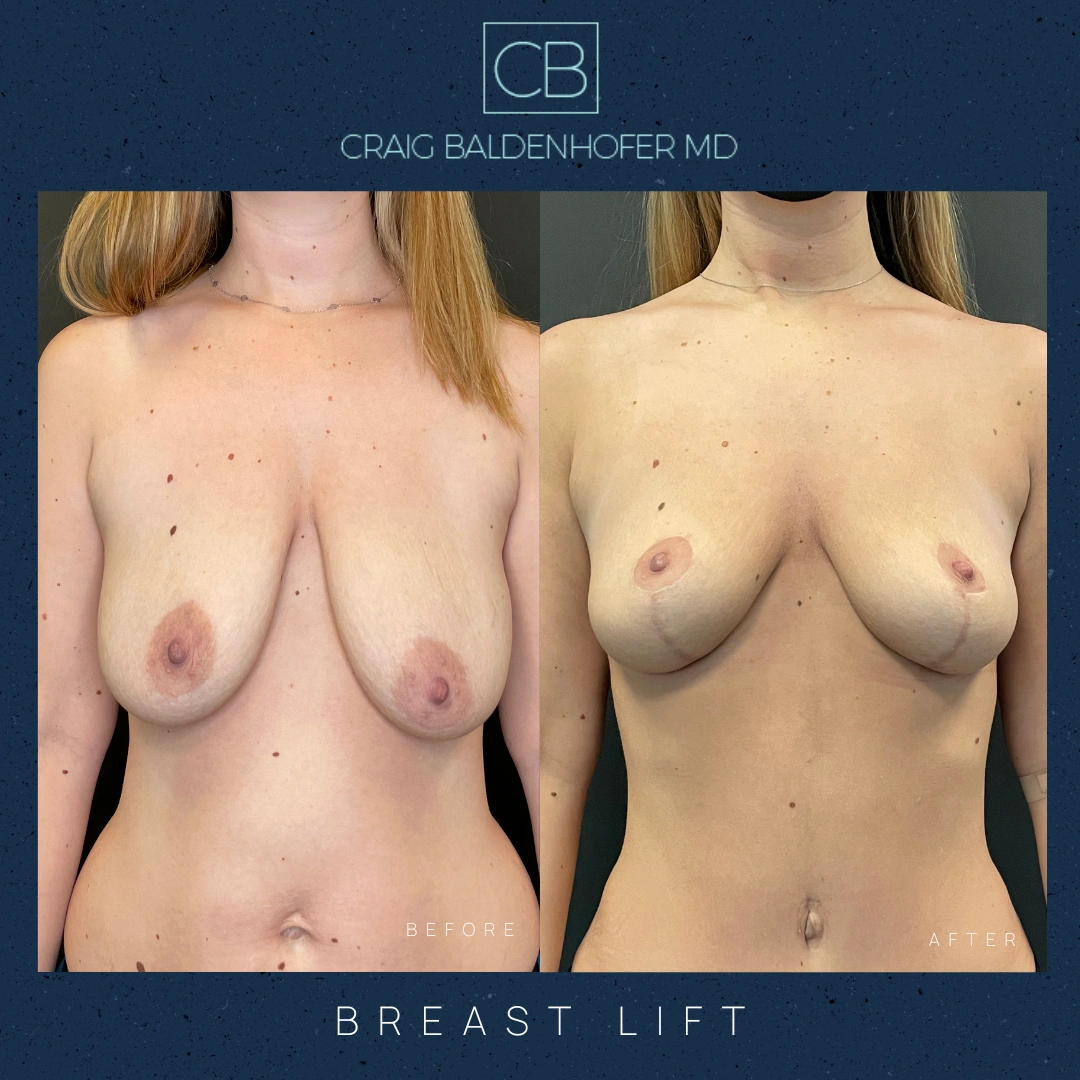 Real patient results in New York, NY Done by Craig Baldenhofer, MD