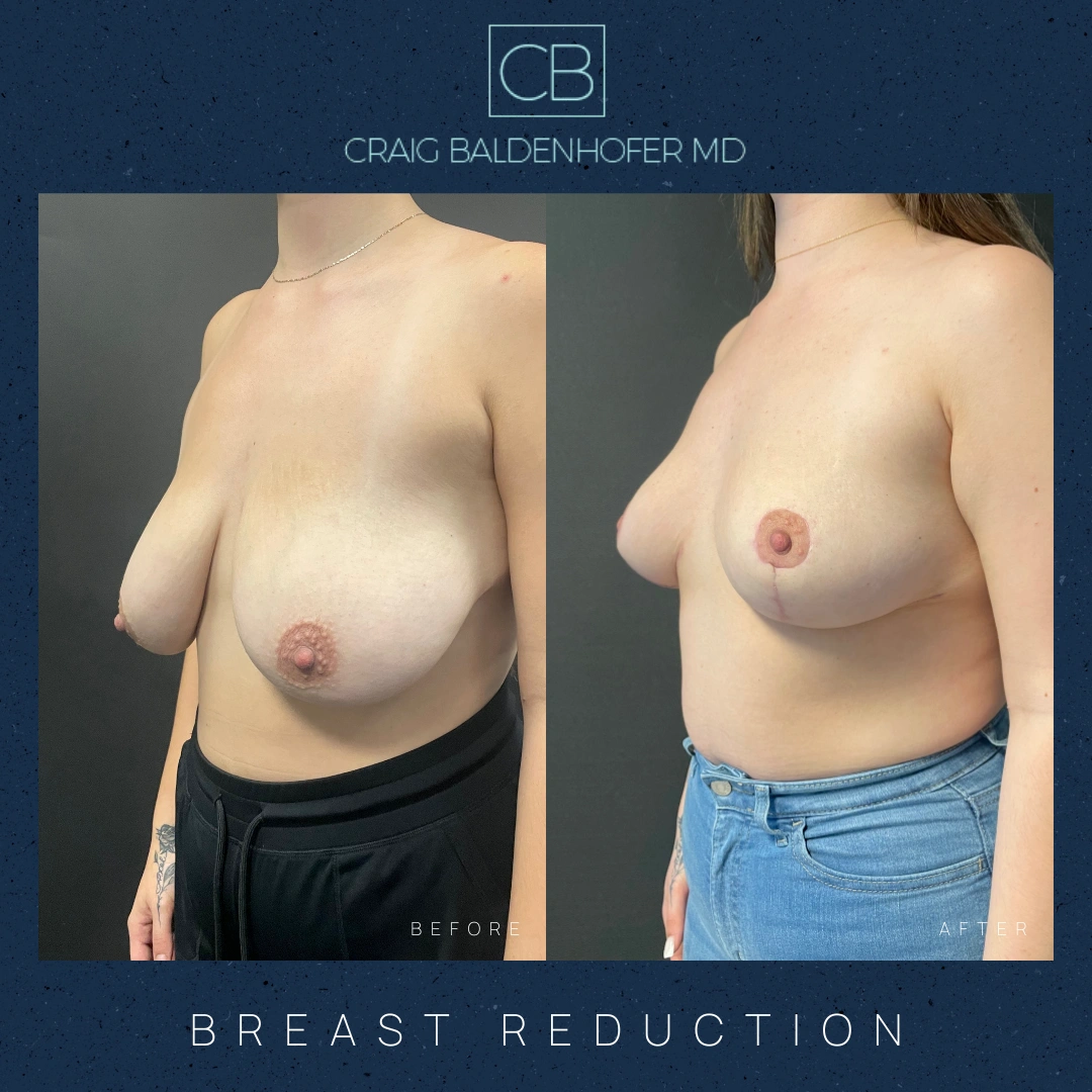 Real patient results in New York, NY Done by Craig Baldenhofer, MD