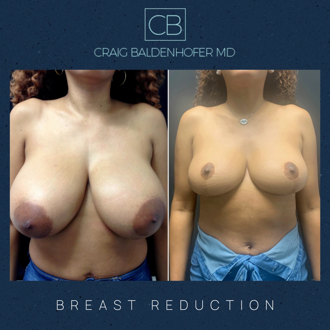 Real patient results in New York, NY Done by Craig Baldenhofer, MD