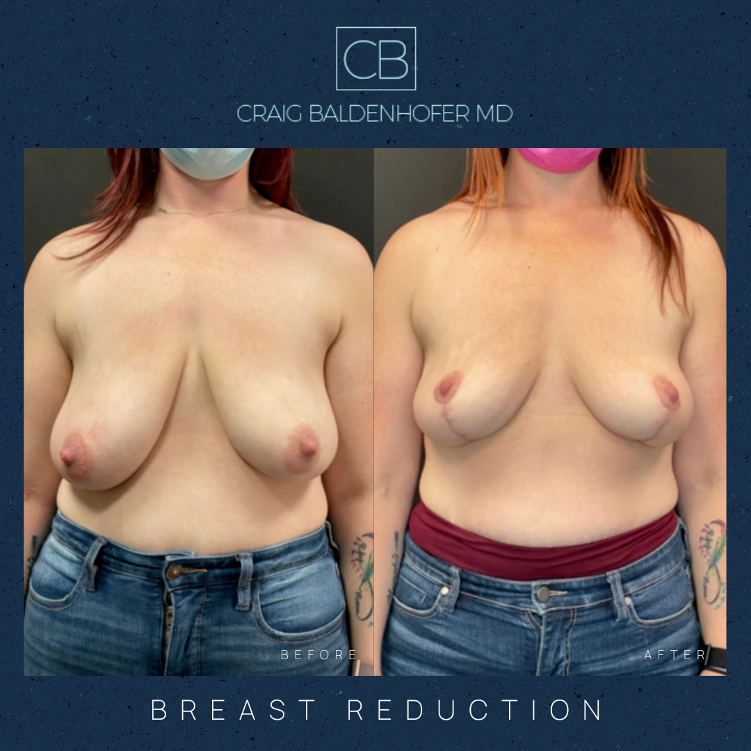 Real patient results in New York, NY Done by Craig Baldenhofer, MD