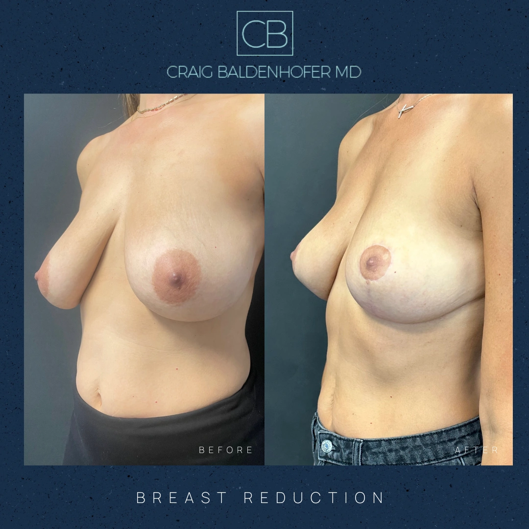 Real patient results in New York, NY Done by Craig Baldenhofer, MD