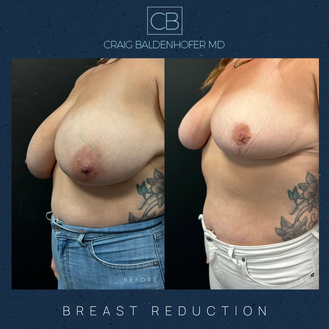 Real patient results in New York, NY Done by Craig Baldenhofer, MD