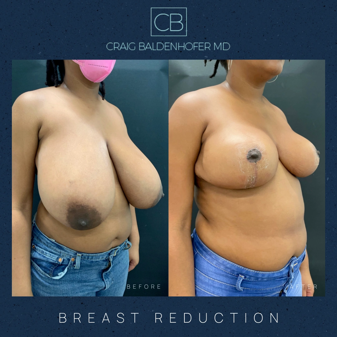 Real patient results in New York, NY Done by Craig Baldenhofer, MD