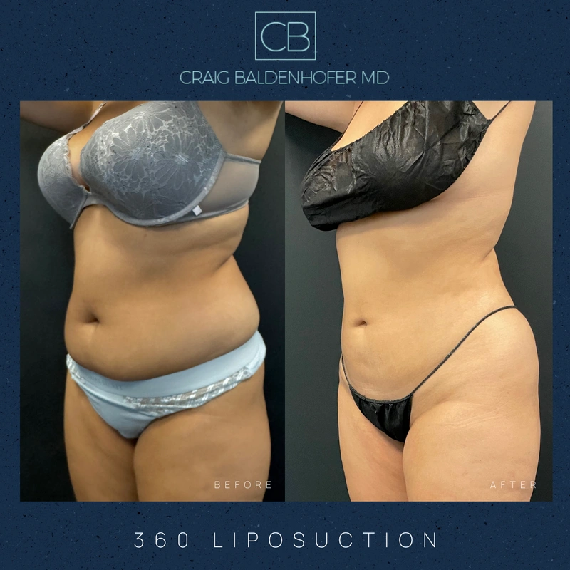 Real patient results in New York, NY Done by Craig Baldenhofer, MD