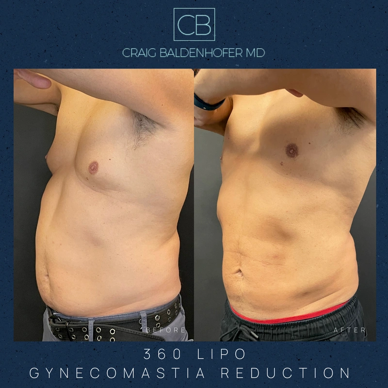 Real patient results in New York, NY Done by Craig Baldenhofer, MD