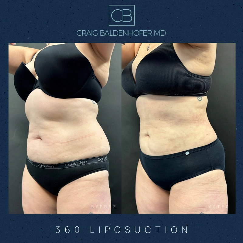 Real patient results in New York, NY Done by Craig Baldenhofer, MD