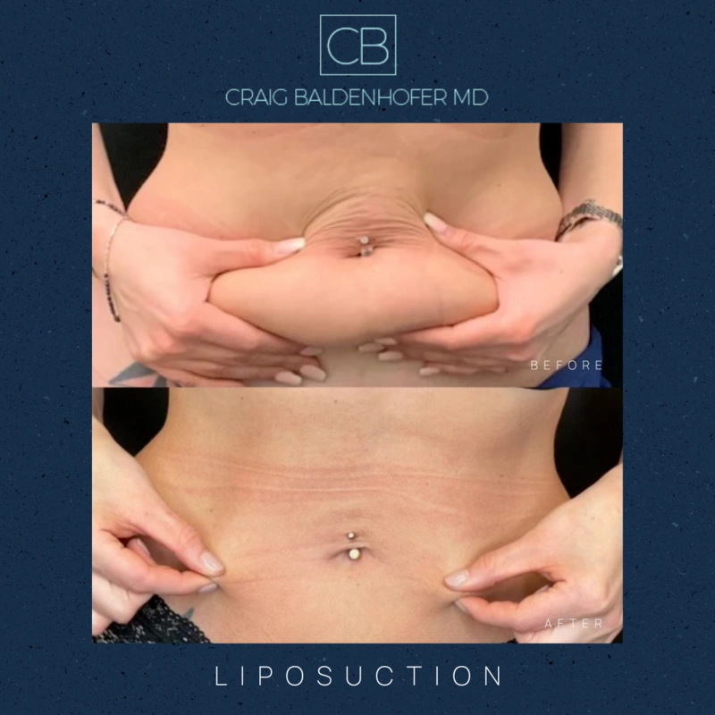 Real patient results in New York, NY Done by Craig Baldenhofer, MD