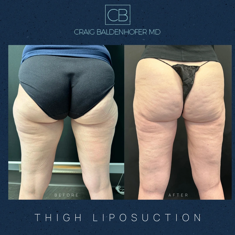 Real patient results in New York, NY Done by Craig Baldenhofer, MD