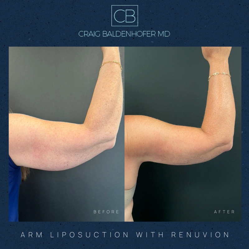 Real patient results in New York, NY Done by Craig Baldenhofer, MD