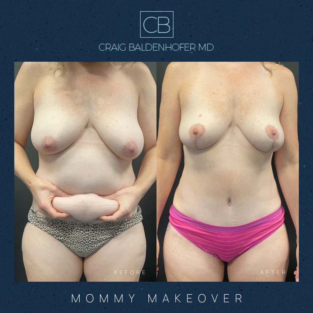 Real patient results in New York, NY Done by Craig Baldenhofer, MD