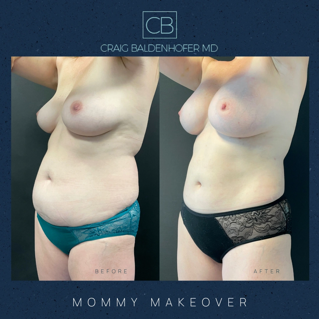 Real patient results in New York, NY Done by Craig Baldenhofer, MD