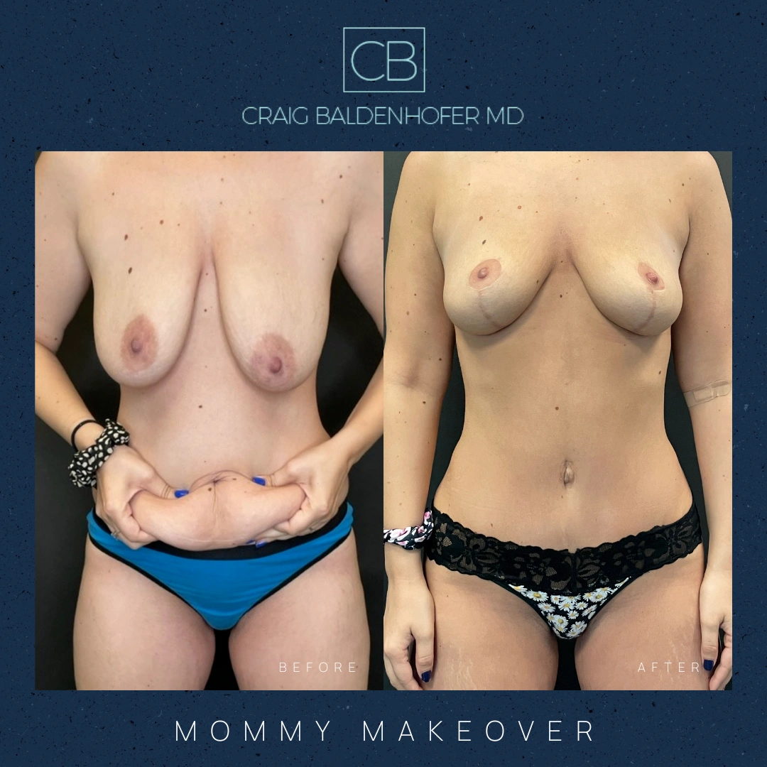 Real patient results in New York, NY Done by Craig Baldenhofer, MD