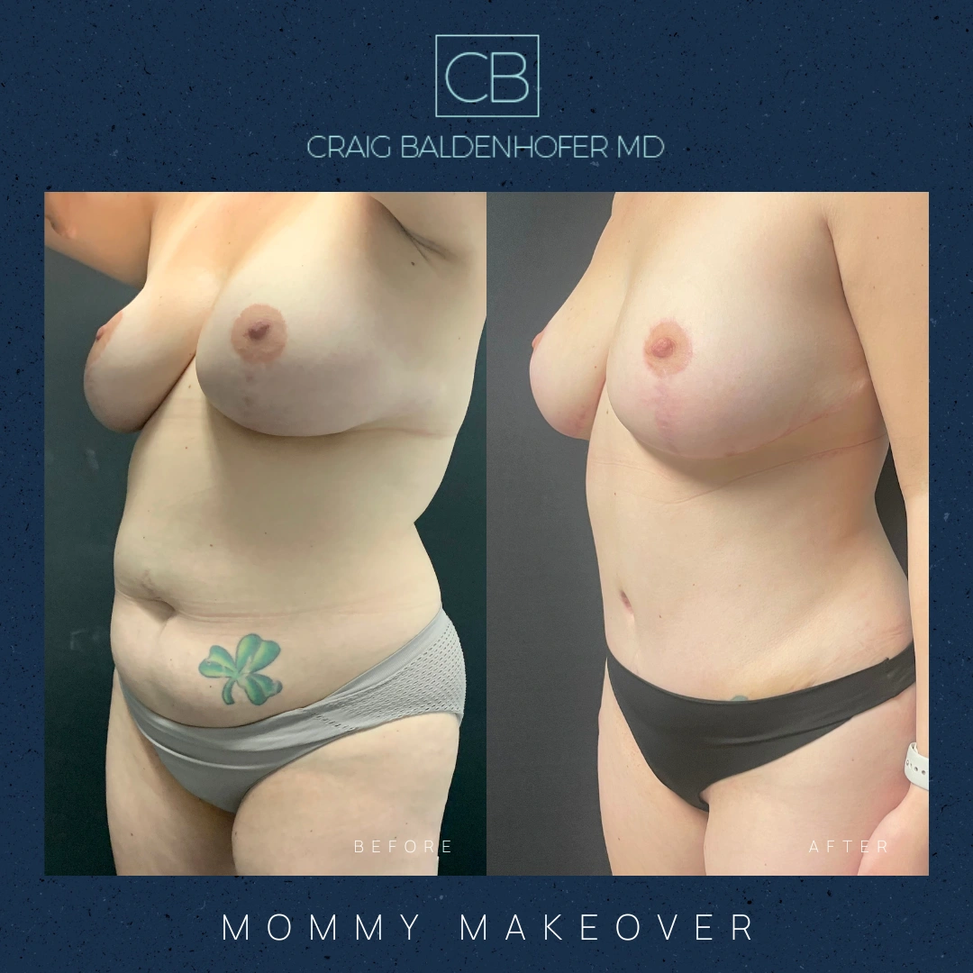 Real patient results in New York, NY Done by Craig Baldenhofer, MD