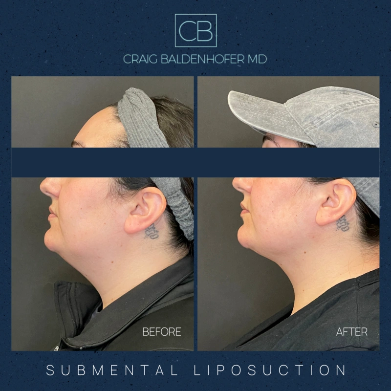 Real patient results in New York, NY Done by Craig Baldenhofer, MD
