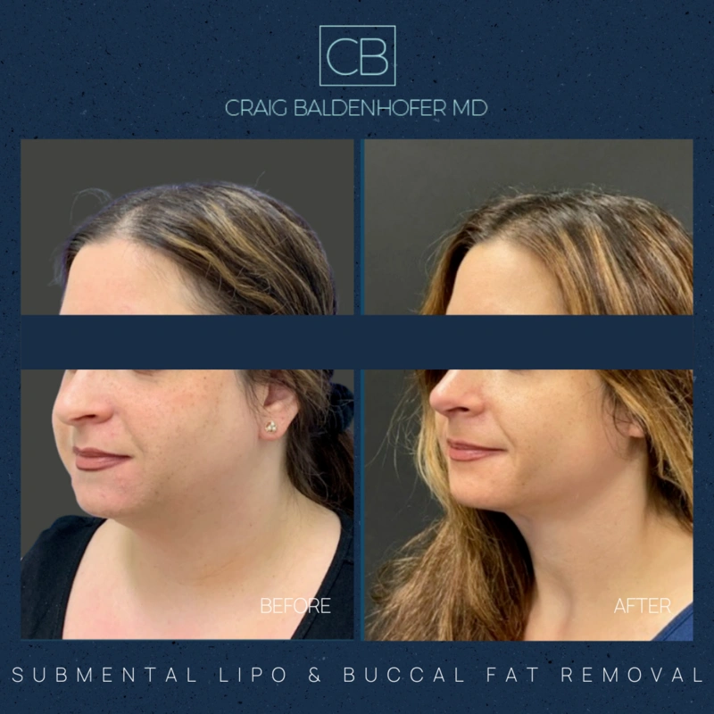 Real patient results in New York, NY Done by Craig Baldenhofer, MD