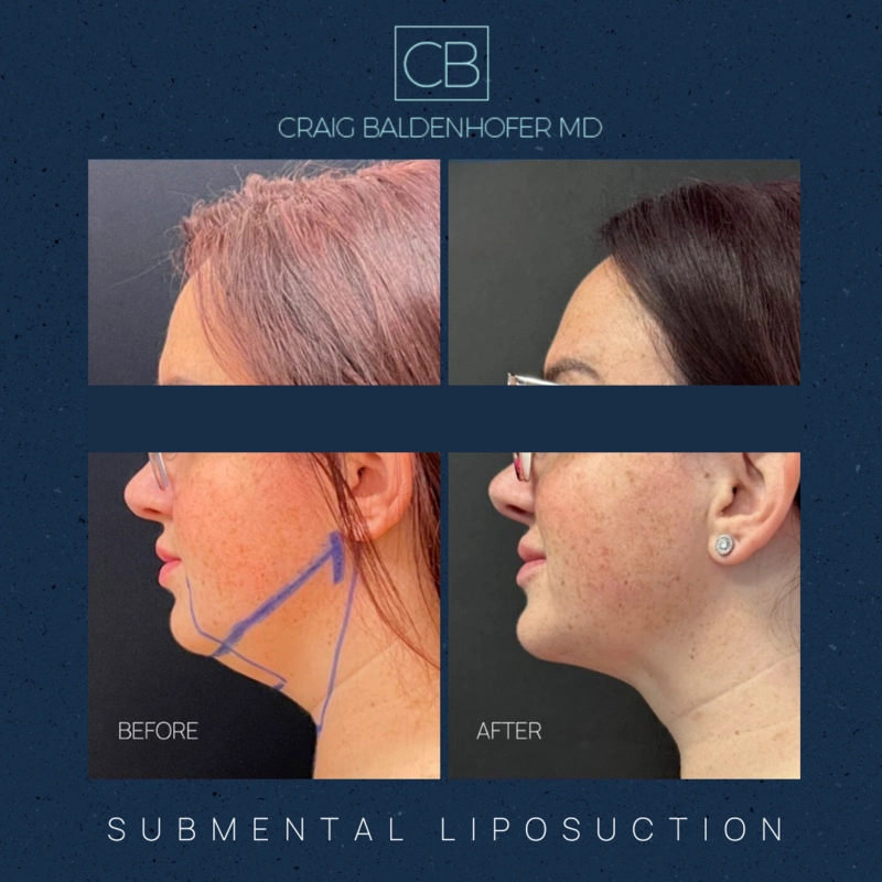 Real patient results in New York, NY Done by Craig Baldenhofer, MD