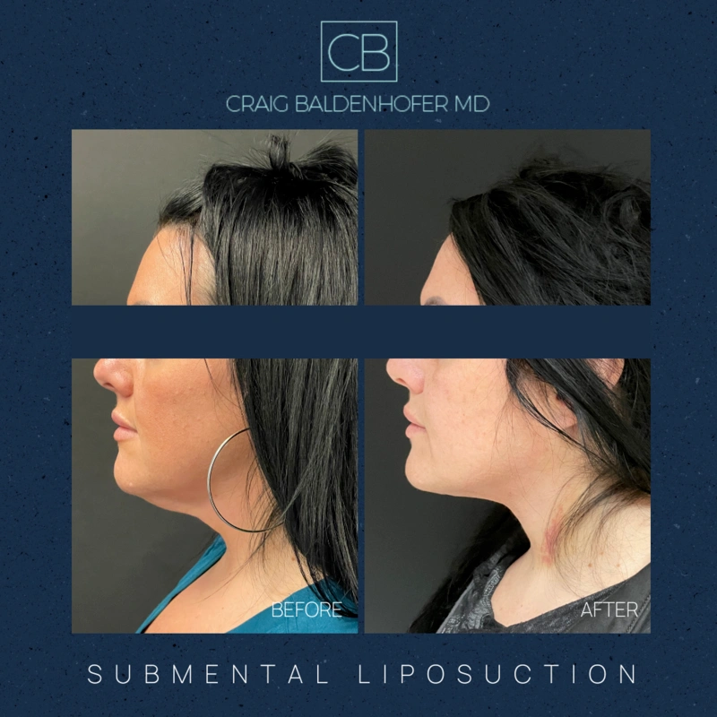 Real patient results in New York, NY Done by Craig Baldenhofer, MD
