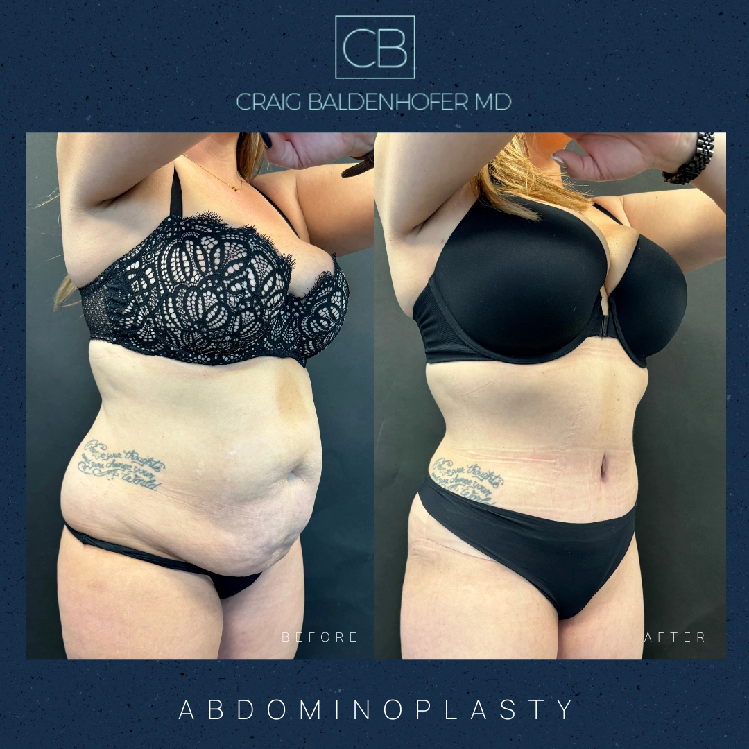 Real patient results in New York, NY Done by Craig Baldenhofer, MD