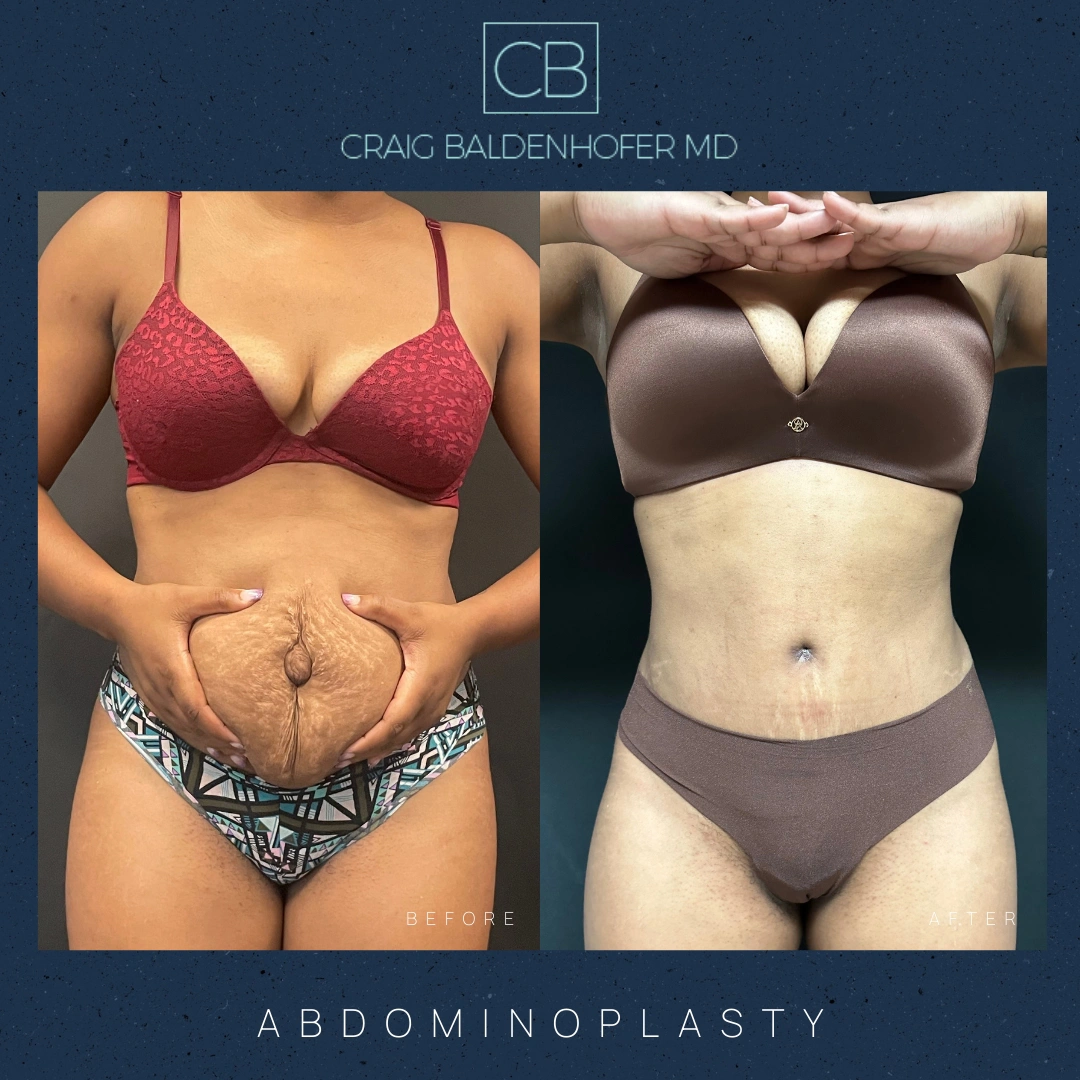 Real patient results in New York, NY Done by Craig Baldenhofer, MD