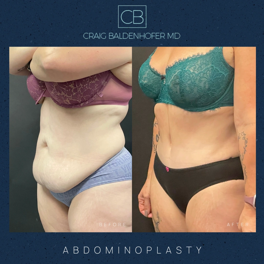 Real patient results in New York, NY Done by Craig Baldenhofer, MD