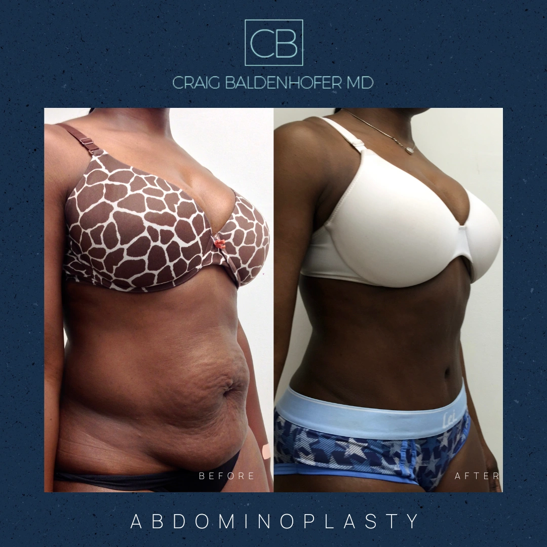 Real patient results in New York, NY Done by Craig Baldenhofer, MD